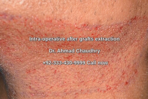 Beard hair extraction Lahore Pakistan