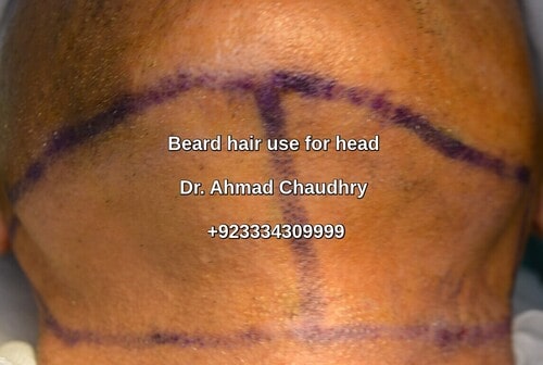 Beard hair use -hair transplant