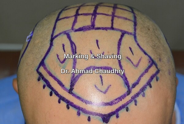 Blue surgical marking and shaving -Fue procedure