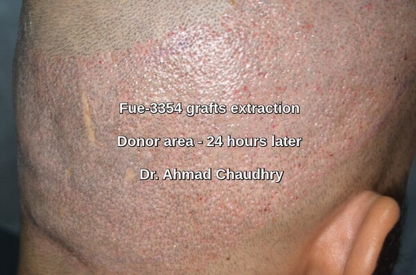 Donor area- 3354 grafts- Sialkot patient