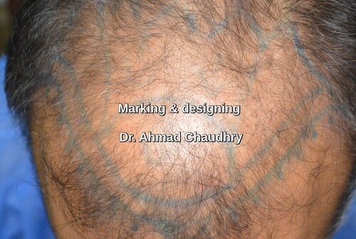 Frontal baldness treatment marking