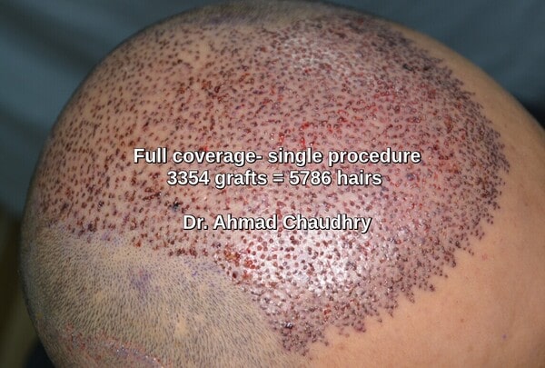 Hair transplant Sialkot patient