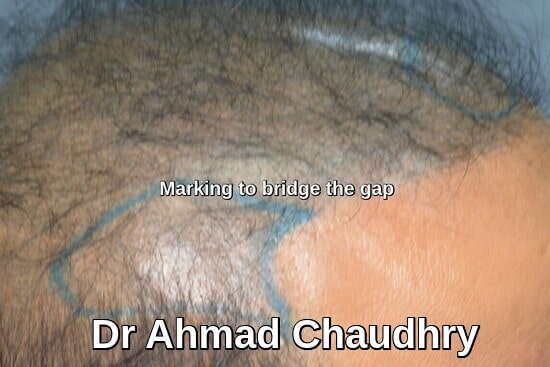 Hair transplant repair Faisalabad patient