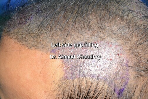 Left lateral hump fue procedure