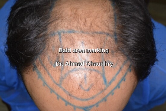 Sialkot patient- marking before hair restoration procedure