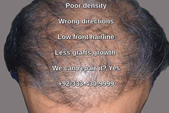 Avoid hair transplant pitfalls