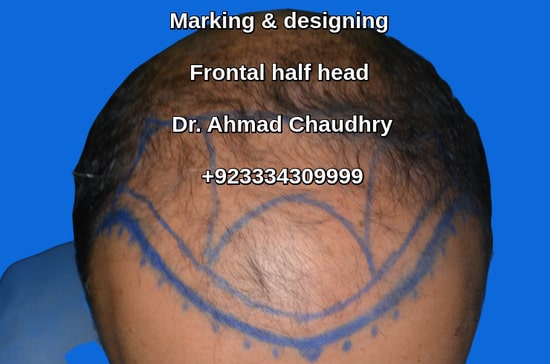 Baldness marking before treatment