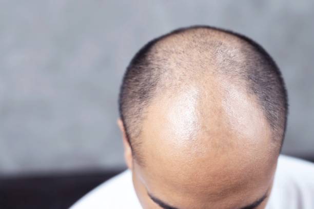 Baldness solution men