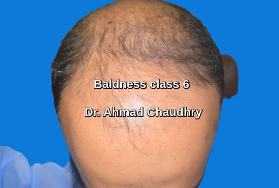 Hair transplant Gujrat