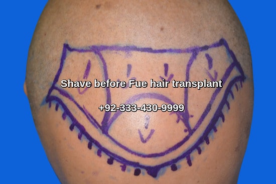 Shave before Fue hair restoration procedure