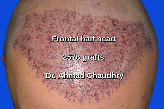 2576 grafts frontal baldness area