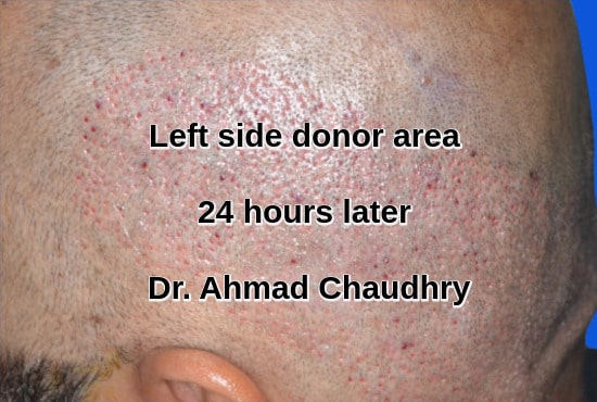 Left side scalp donor area