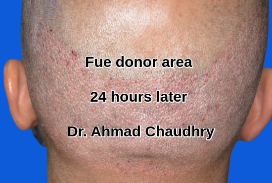 scalp donor area