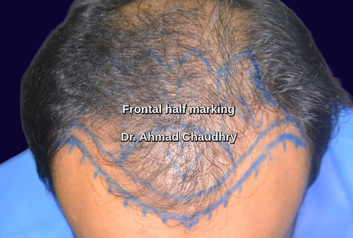 Frontal baldness marking