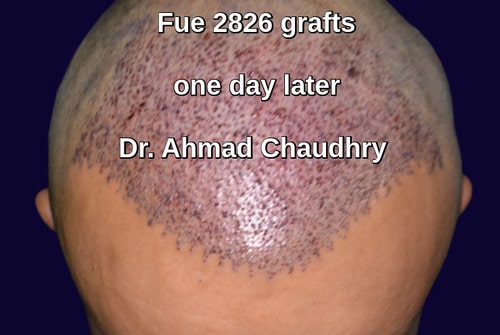 Fue 2826 grafts recipient area