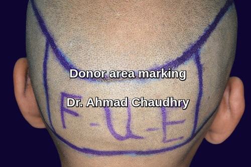 Fue hair transplant donor area marking