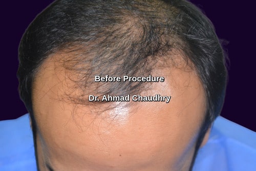 Hair transplant Al Ahsa patient