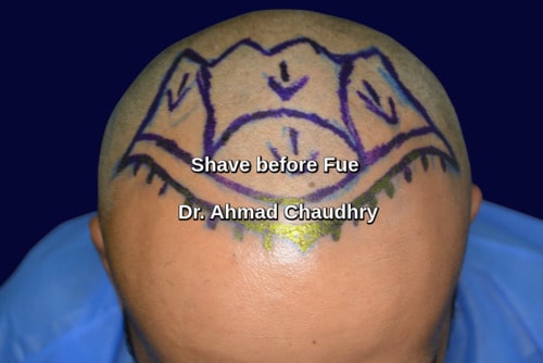 Shave before Fue procedure Saudi Arabia customer