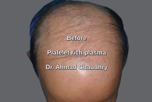 platelet rich plasma treatment Lahore Pakistan