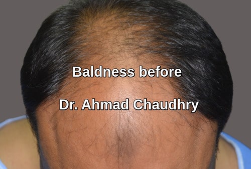 Hair transplant Faisalabad