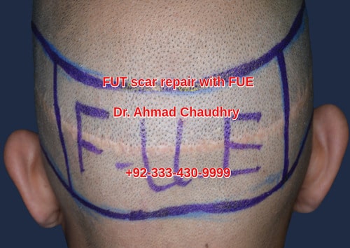 Scar correction specialist Lahore Pakistan