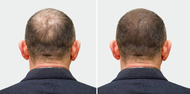 Best hair transplant method Pakistan