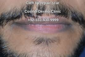 Cleft lip scar fixing Pakistan
