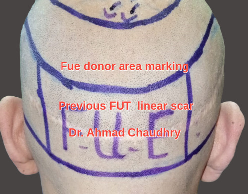 Fue donor area marking Pakistan