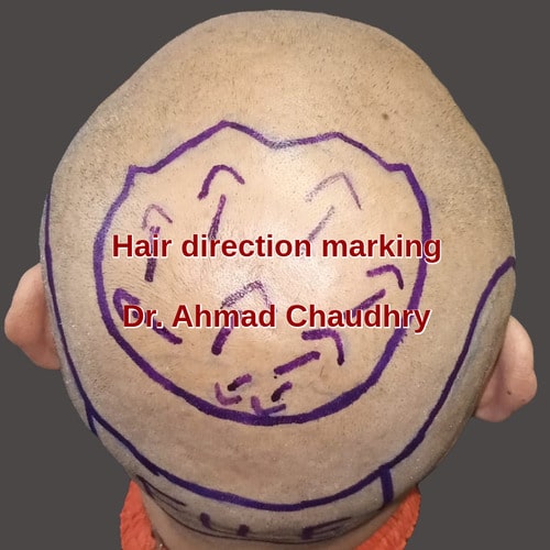 Hair direction crown area designing