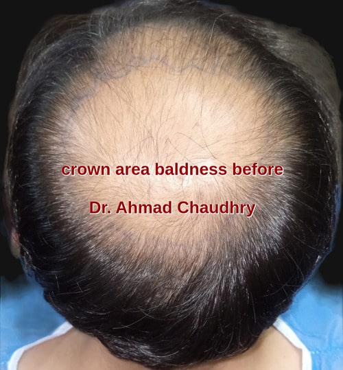 Hair transplant Sahiwal patient