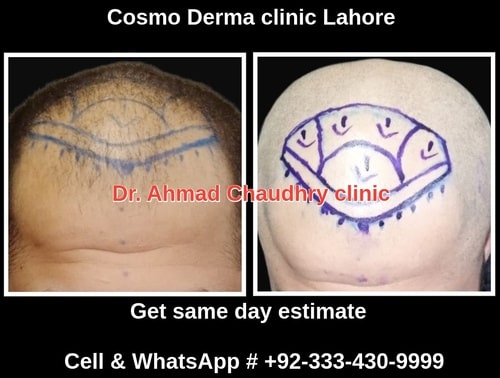 Procedure of hair transplant Pakistan