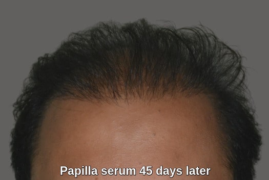 45 days later hair regrowth serum result