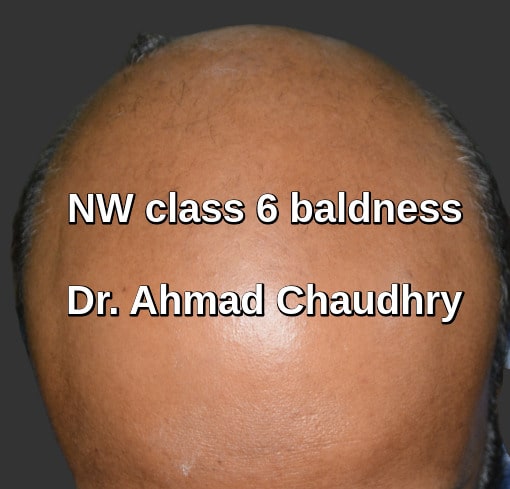 Baldness class 6 treatment
