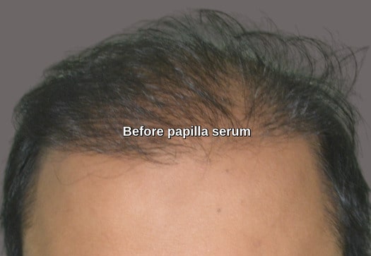 Before Papilla serum