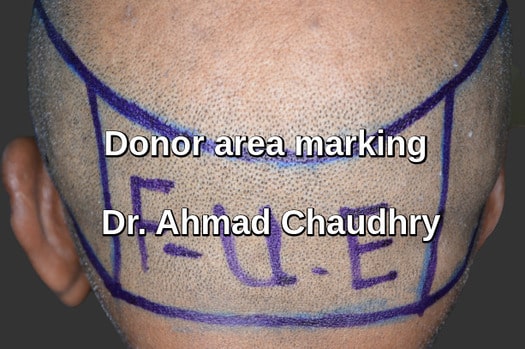 Fue donor area marking before procedure
