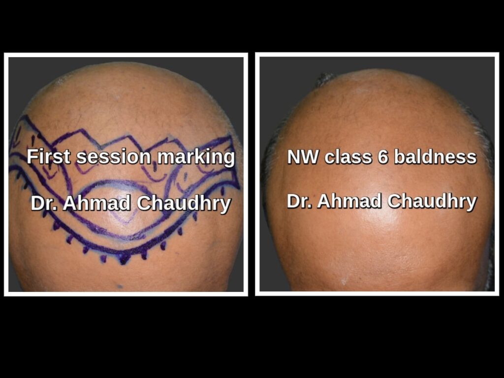 Hair transplant Sargodha patient