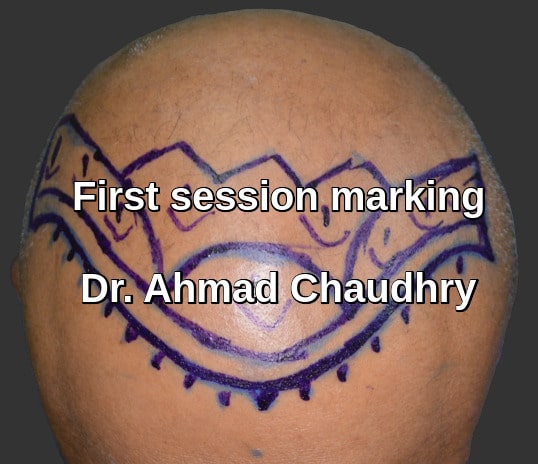 Marking before hair restoration Sargodha patient