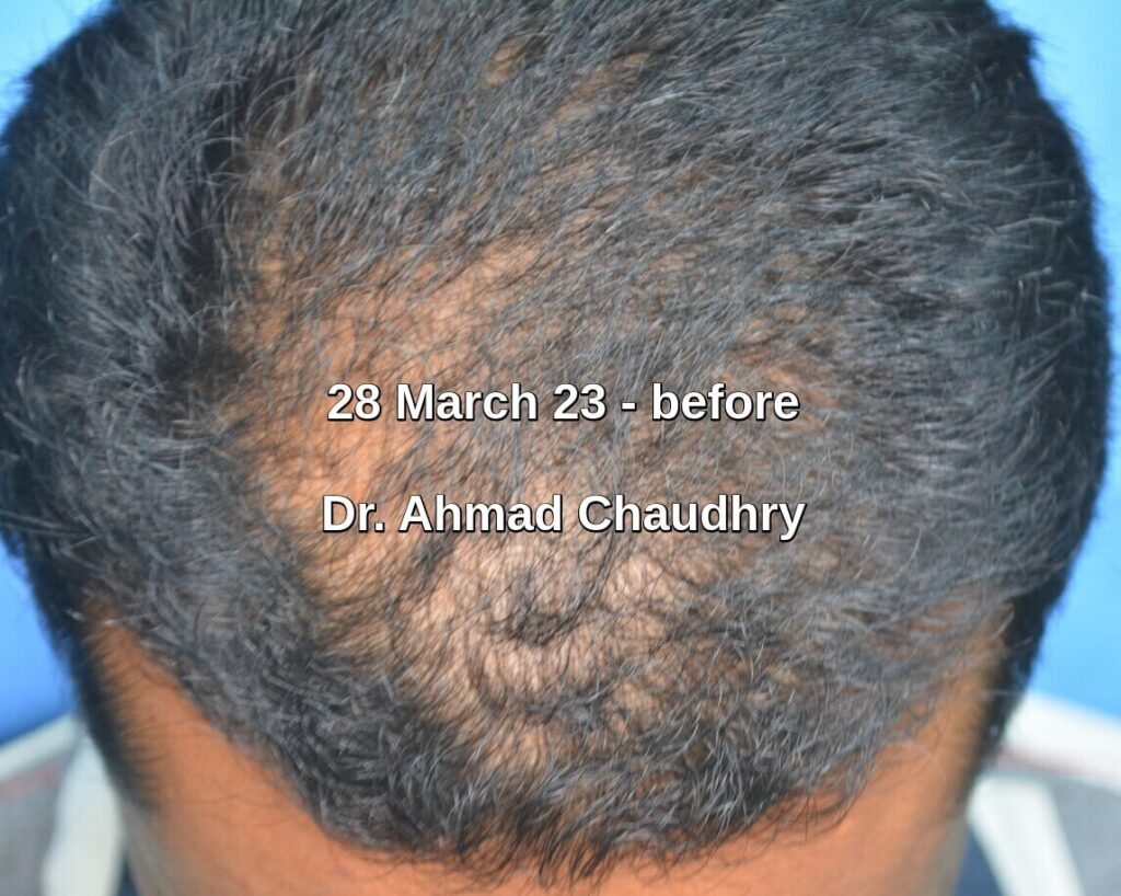 Exosome hair therapy Pakistan before