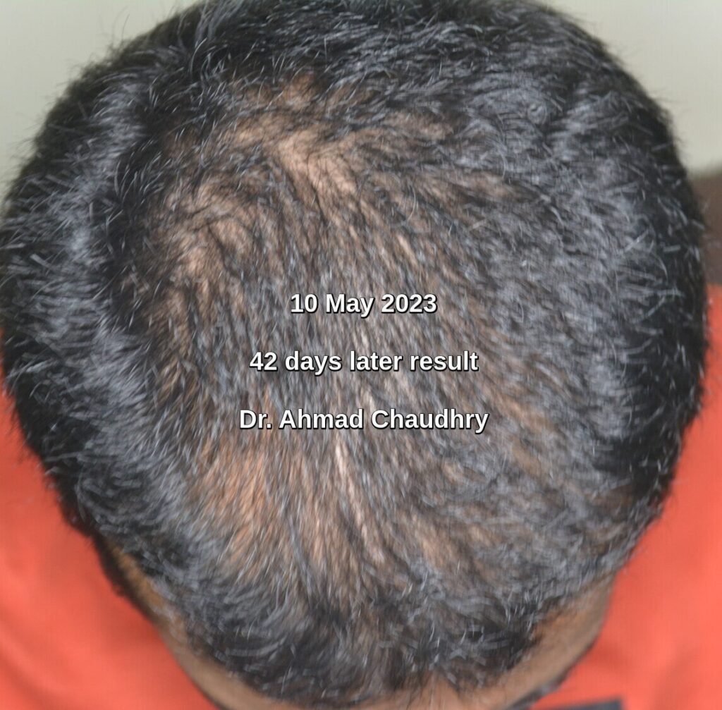 Result exosome hair therapy Pakistan