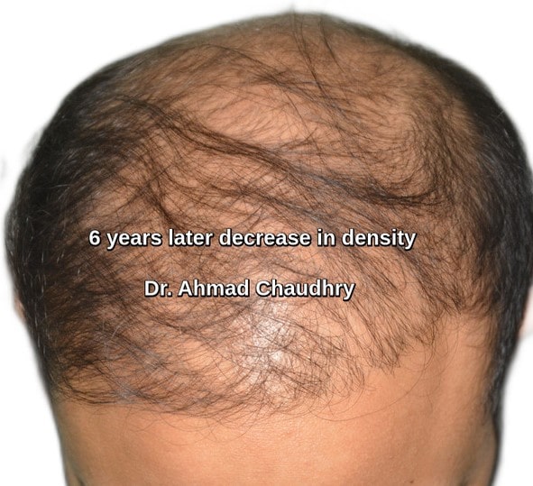 Decrease density transplanted hair six years later