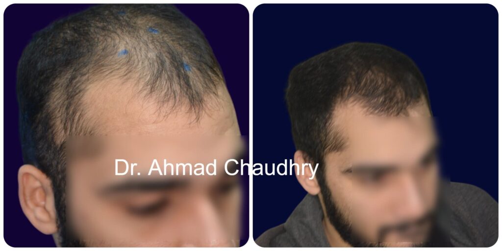 Hair loss treatment Pakistan right view