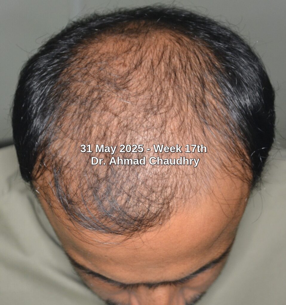 Hair loss can be reversed Hair loss can be reversed